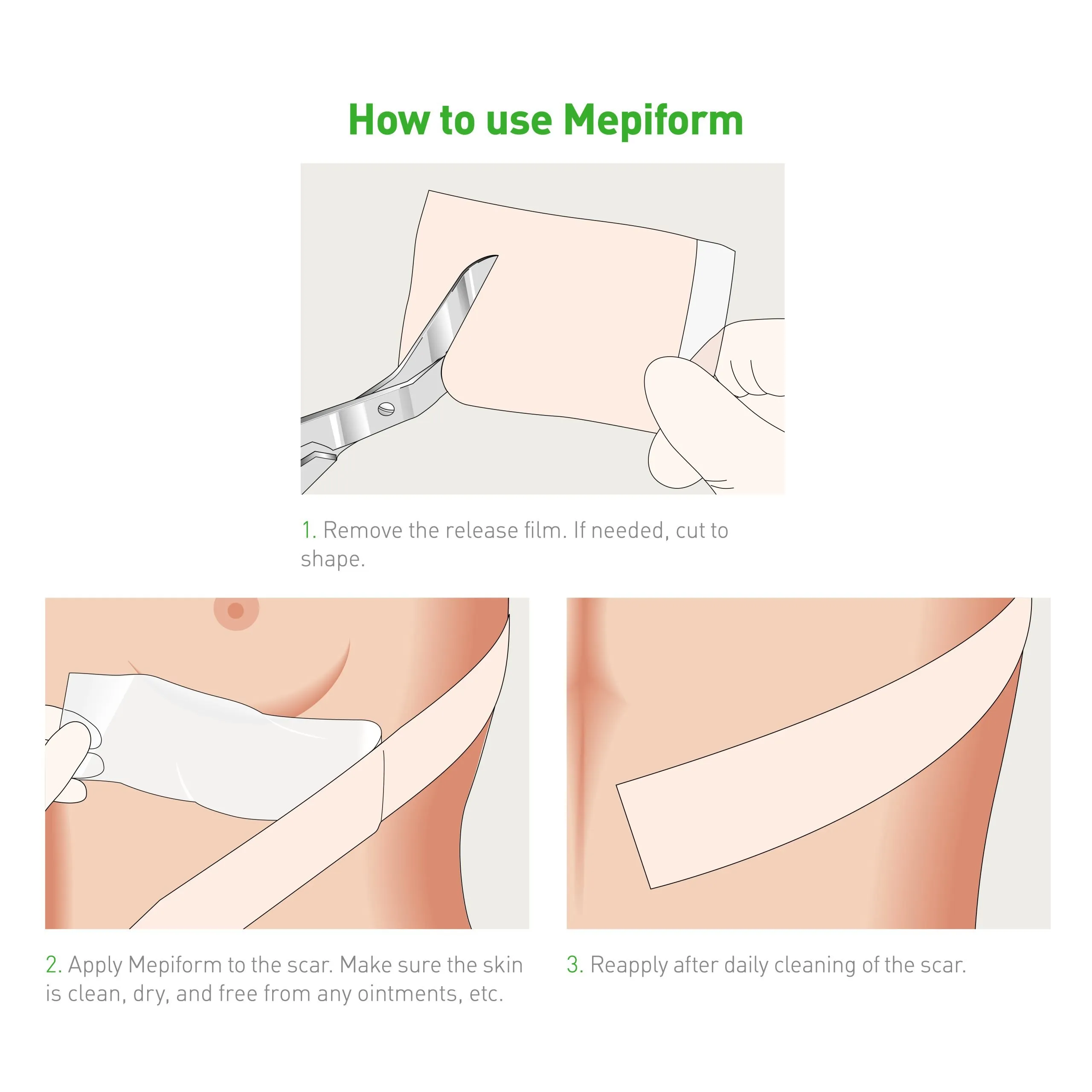 Mölnlycke Mepiform Scar Reduction Dressings - Image 7
